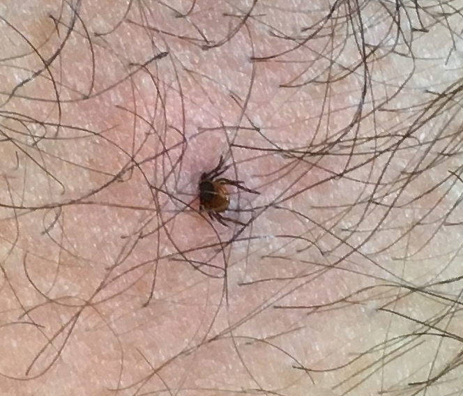 tick-close-up-embedded-in-skin tick-close-up-embedded-in-skin